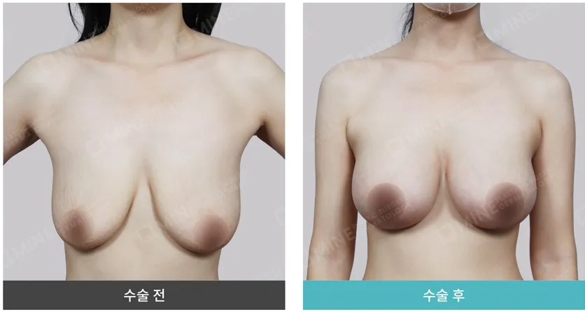 Before-and-after comparison photo of a breast lift surgery showing improved breast shape and volume with minimal visible breast lift surgery scar.
