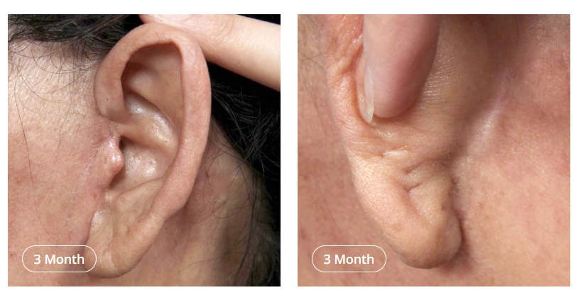 Behind-the-ear incision healing at 3 months showing natural recovery of facelift and neck lift scar.