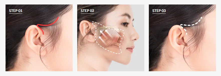 Mini facelift surgery step-by-step illustration showing incision line behind the ear, skin lifting direction, and before-and-after facial contour improvement.