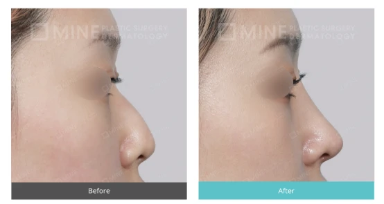 Before and after side profile comparison of a patient with low nose rhinoplasty, showing improved nasal bridge height and smoother nose contour.