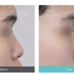 Low nose rhinoplasty before and after case.