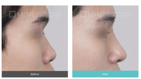 Low nose rhinoplasty before and after case.