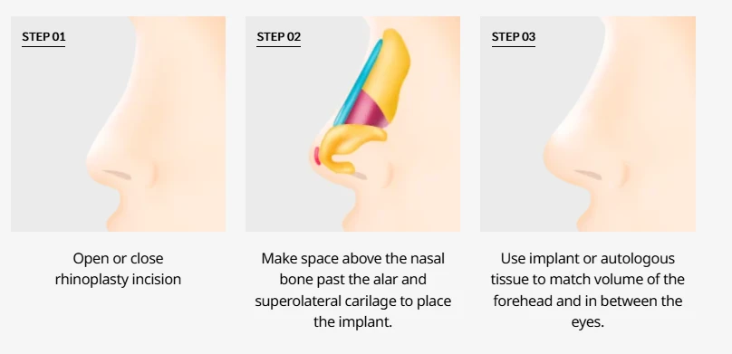 Step-by-step illustration of low nose rhinoplasty procedure, showing incision approach, implant space creation above the nasal bone, and volume augmentation using implant or autologous tissue for natural nasal bridge enhancement.