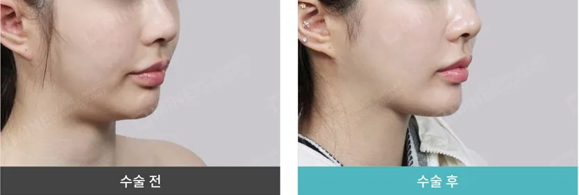 Before and after results of salivary gland reduction showing a slimmer jawline and improved submental contour.