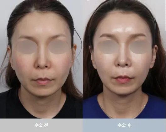 Mini facelift surgery diagram and clinical before-and-after photos showing localized lifting technique and natural facial rejuvenation results.