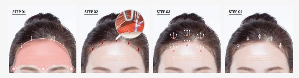 Step-by-step illustration of an endoscopic forehead lift procedure showing incision placement, endoscopic dissection, lifting vectors, and fixation for forehead rejuvenation.
