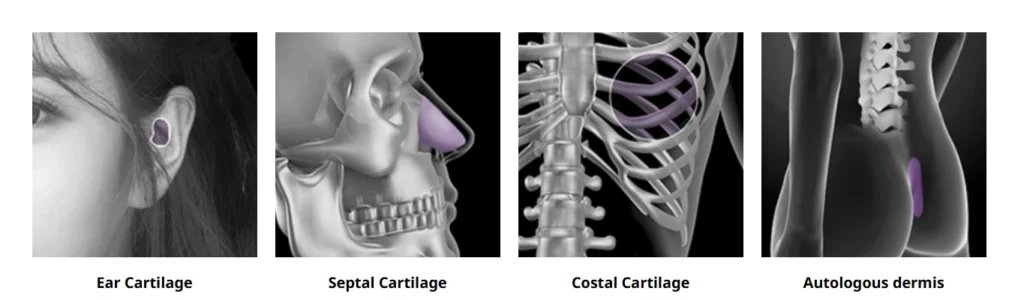 Autologous rhinoplasty with cartilage showing donor sources including ear cartilage, septal cartilage, costal cartilage, and autologous dermis used for nasal reconstruction.