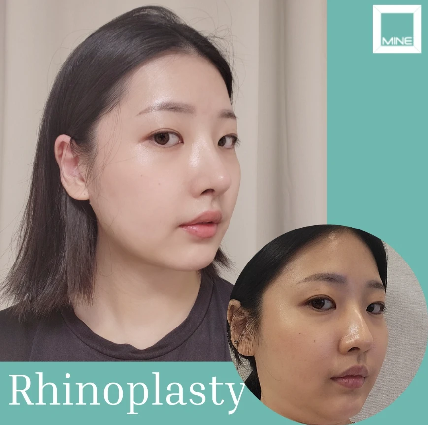 Before and after side profile results of autologous rhinoplasty with cartilage, showing natural nasal contour improvement using the patient’s own cartilage.