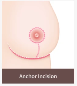 Anchor incision breast lift method illustration showing periareolar, vertical, and inframammary incisions used to correct moderate to severe breast sagging.