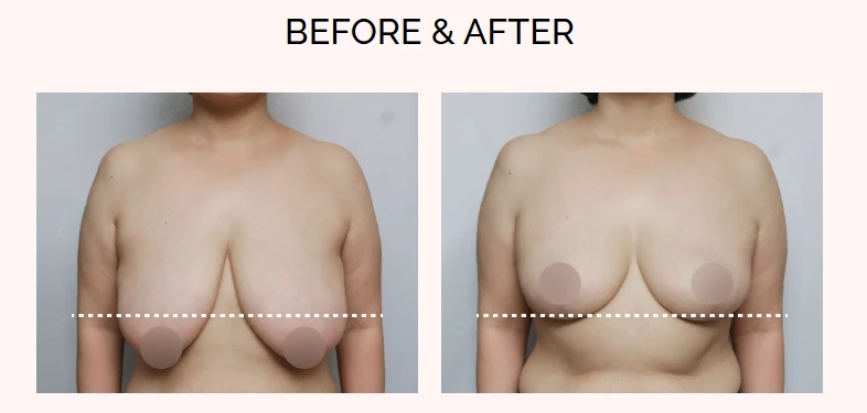 Before and after comparison image demonstrating the breast lift method, showing improved breast position, shape, and symmetry following surgical correction of sagging.