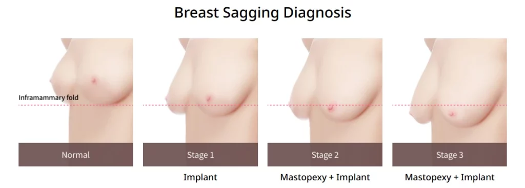 Breast sagging diagnosis chart showing normal breasts and stage 1 to stage 3 ptosis, illustrating appropriate breast lift method selection including implant-only and mastopexy with implant options.