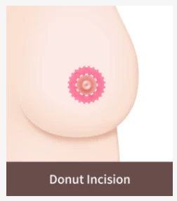 Donut incision breast lift method illustration showing a circular periareolar incision used to correct mild breast sagging with minimal scarring.