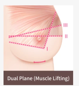 Illustration of the dual plane breast lift method showing muscle lifting vectors and implant positioning to improve breast sagging and lower pole support.