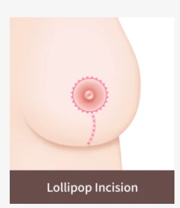 Lollipop incision breast lift method illustration showing a periareolar and vertical incision technique used to improve moderate breast sagging while limiting scar length.
