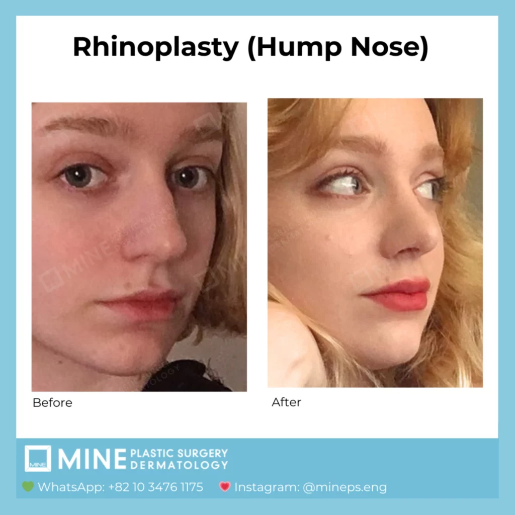 Before and after frontal-angle comparison demonstrating Dorsal Hump Removal through Hump Nose Rhinoplasty, showing a smoother nasal bridge and improved facial balance.