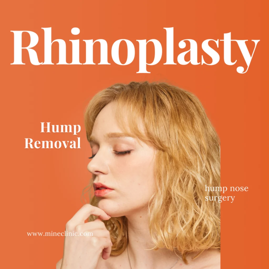 Promotional rhinoplasty image highlighting Dorsal Hump Removal and Hump Nose Rhinoplasty, showing a refined side profile after hump correction.