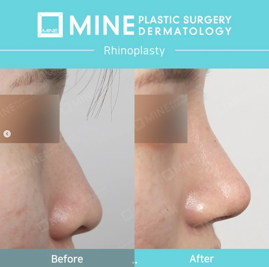 Before and after side profile comparison showing nasal shape refinement and smoother bridge, demonstrating Rhinoplasty In Korea with natural, balanced results.