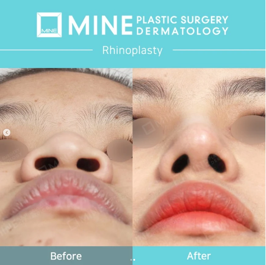 Before and after underside view of the nose showing improved nostril shape and nasal tip definition, illustrating Rhinoplasty In Korea with refined, symmetrical results.