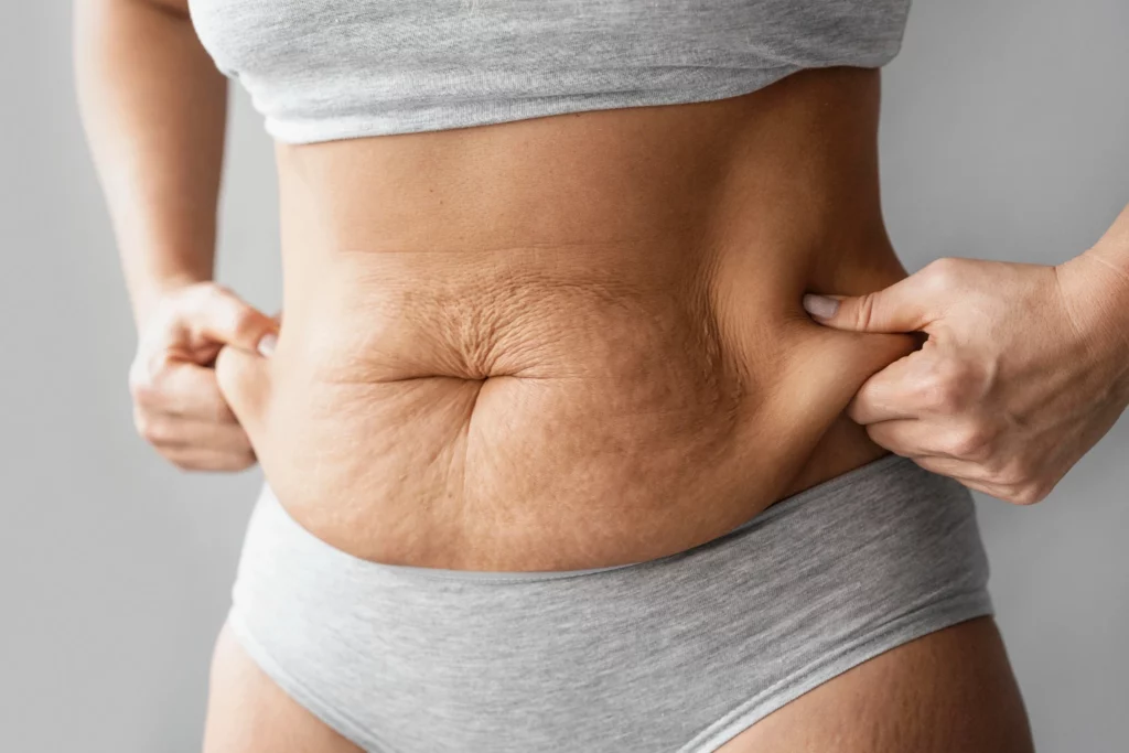 Female with stretch marks and sagging stomach in need of tummy tuck surgery.