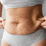Female with stretch marks and sagging stomach in need of tummy tuck surgery.