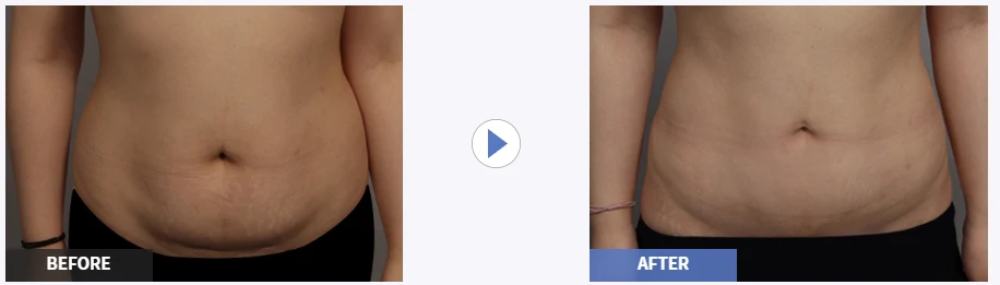 Tummy tuck (abdominoplasty) outcome comparison illustrating smoother abdominal contour and improved skin tightness after abdominal contouring surgery.