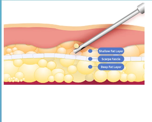 Tummy tuck (abdominoplasty) anatomical illustration showing shallow fat layer, Scarpa’s fascia, and deep fat layer involved in abdominal contouring surgery.