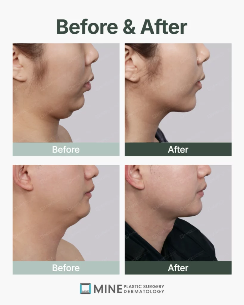 Before and after comparison photos of double chin surgery showing improved jawline contour and reduced submental fullness in female and male patients.