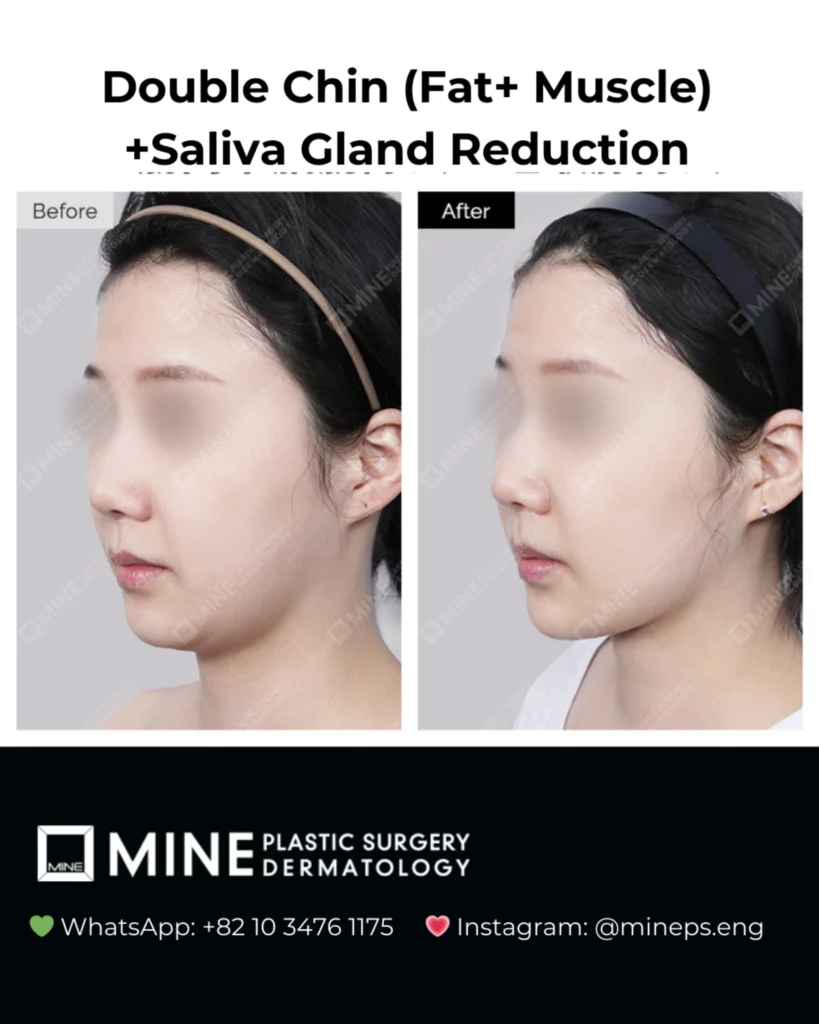 Before and after results of double chin surgery with fat removal, muscle tightening, and salivary gland reduction showing enhanced jawline contour and slimmer lower face profile.