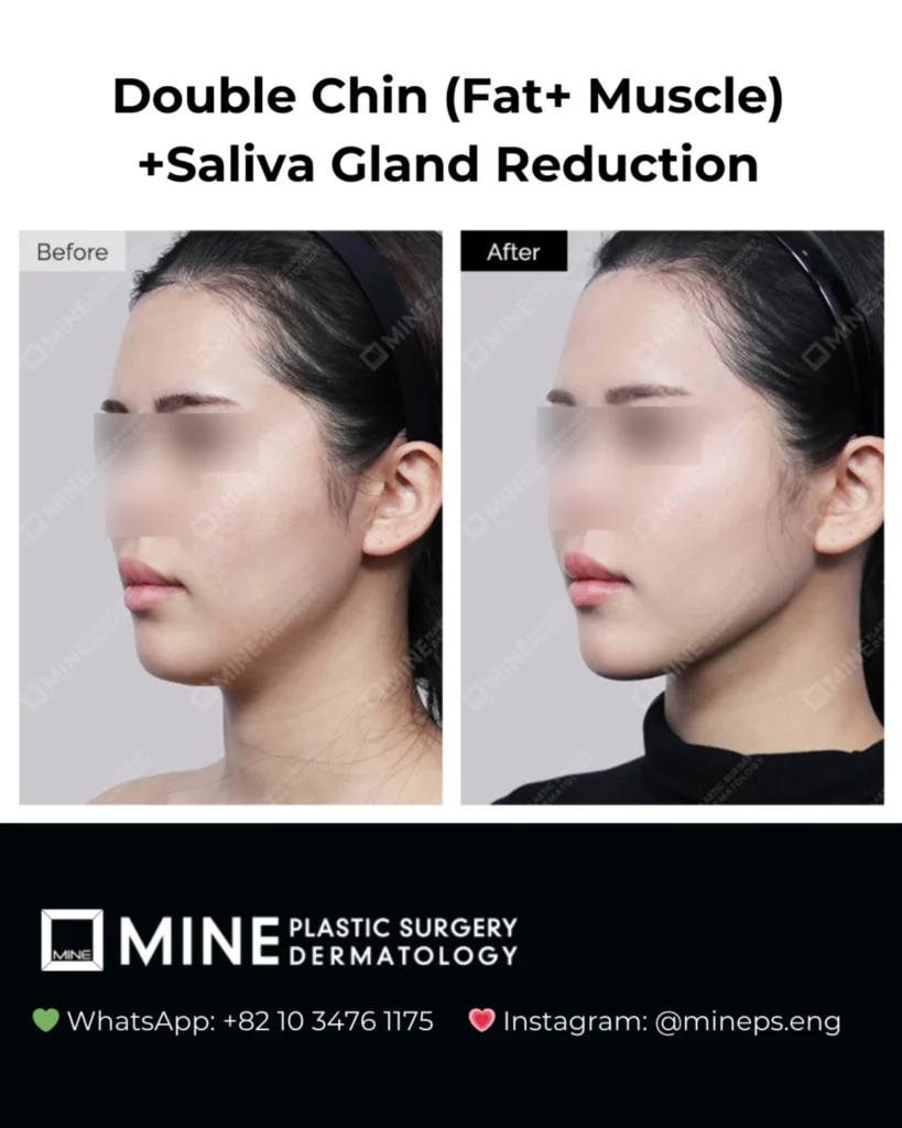 Before and after results of double chin surgery with fat removal, muscle tightening, and salivary gland reduction showing improved jawline definition and slimmer neck contour.