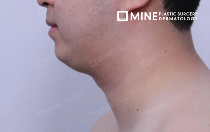 Male patient side profile before double chin surgery showing submental fullness and jawline definition loss prior to double chin surgery treatment.