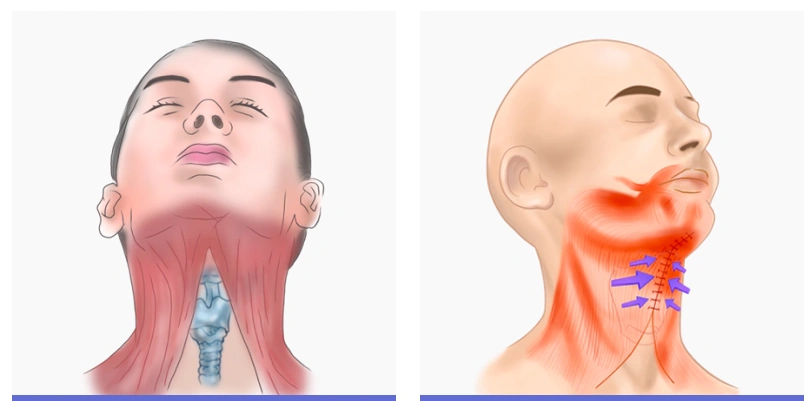 Illustration of platysma muscle tightening and neck contour improvement in double chin surgery showing muscle repositioning and submental area correction.