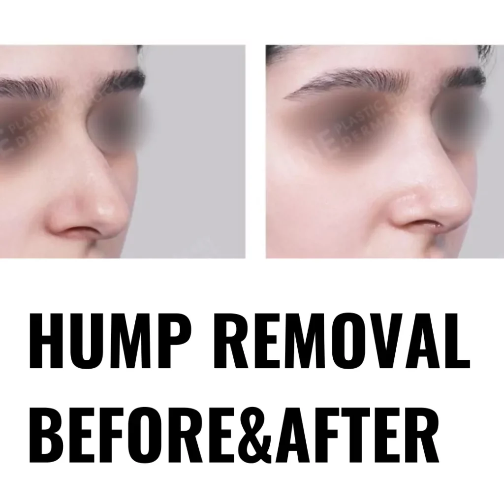 Before and after side profile comparison showing dorsal hump removal and smoother nasal bridge contour following hump nose rhinoplasty.