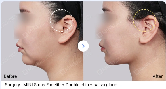 Side profile before and after mini facelift surgery showing improved jawline definition and reduced double chin fullness, with incision area marked near the ear.