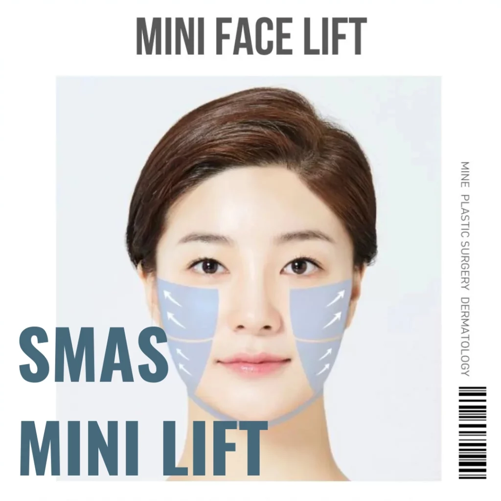 SMAS mini facelift diagram showing facial lifting vectors on cheek and jaw areas, illustrating SMAS layer tightening for lower face rejuvenation at a plastic surgery clinic.