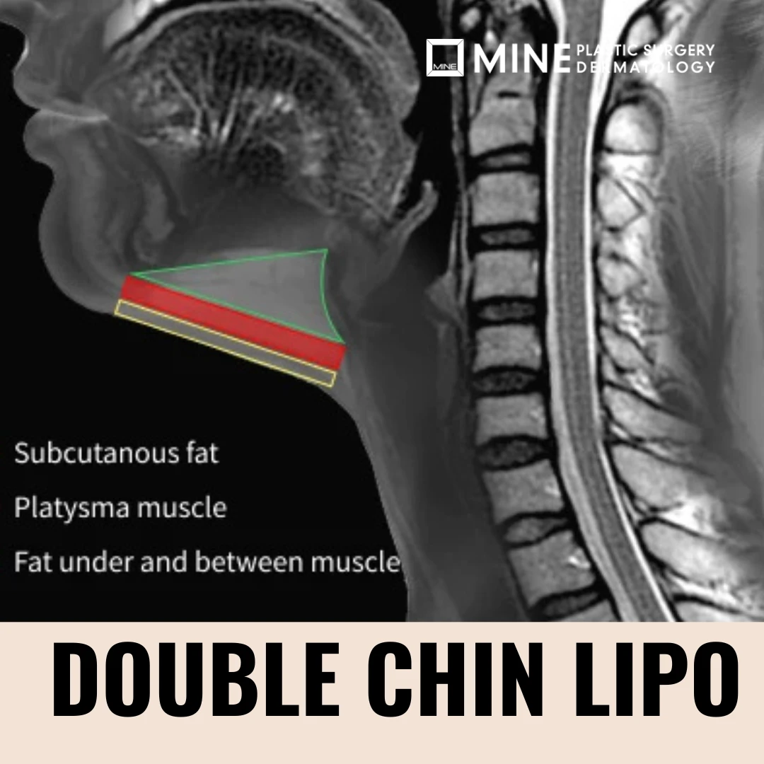 Double chin surgery in Korea — anatomical cross-section diagram showing the 4 submental layers: subcutaneous fat, platysma muscle, subplatysmal fat, and submandibular gland