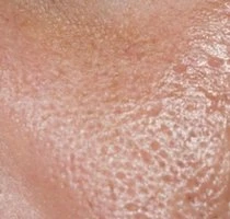 Close-up of dry, dehydrated skin with enlarged pores before Elravie Re2O Skin Booster treatment — showing skin texture that benefits from deep hydration and skin rejuvenation.