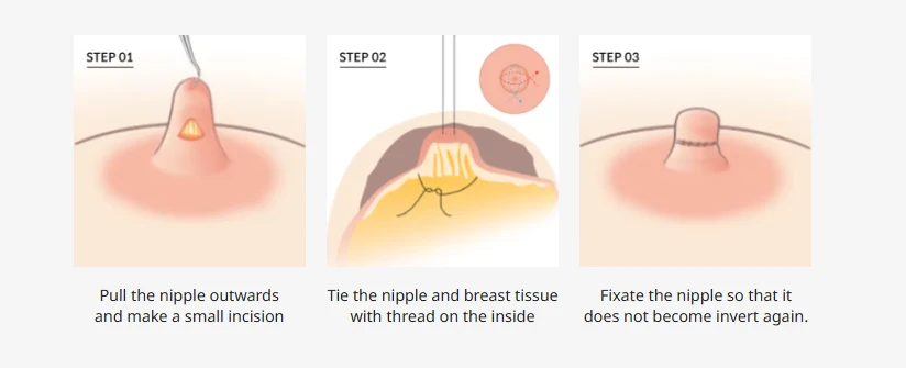 Step-by-step medical diagram illustrating inverted nipple surgery, showing nipple outward traction, internal suturing of breast tissue, and fixation to prevent reinversion.