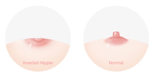 Medical illustration comparing inverted nipple and normal nipple anatomy, demonstrating correction concept for inverted nipple surgery.
