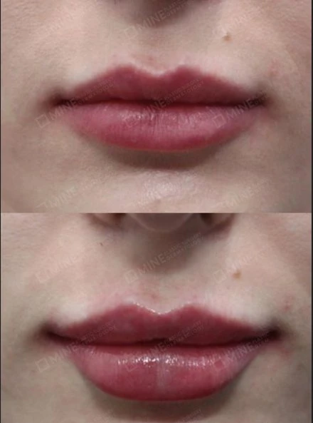 Before and after lip filler at Mine Clinic Seoul — Korean dermatology lip volume and lip line enhancement using Korean brand filler, showing natural fuller lip results.