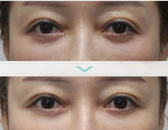 Before and after under-eye rejuvenation treatment at Mine Clinic Seoul — Korean dermatology collagen and elastin injection results showing reduced dark circles and refreshed eye area.