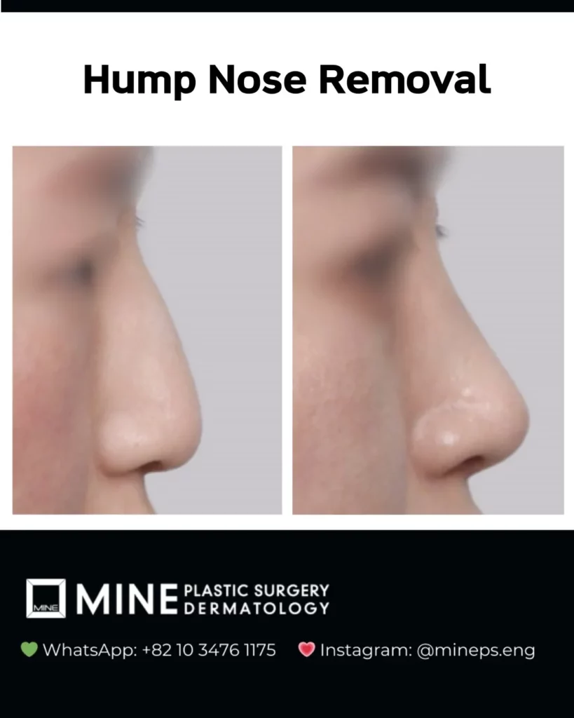 Dorsal hump nose rhinoplasty before and after profile view — female patient, Mine Clinic Seoul Korea.
