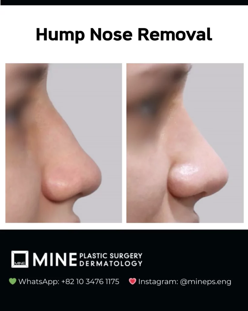 Hump nose rhinoplasty before and after side profile — natural result at Mine Clinic Plastic Surgery Seoul Korea.