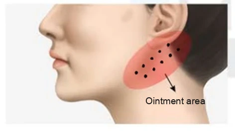 Mini neck lift aftercare diagram showing the ointment application area behind the ear and along the upper neck