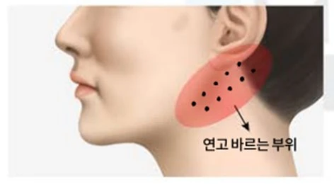 Diagram showing the ointment application zone near the ear and jaw as part of mini neck lift surgery precautions.
