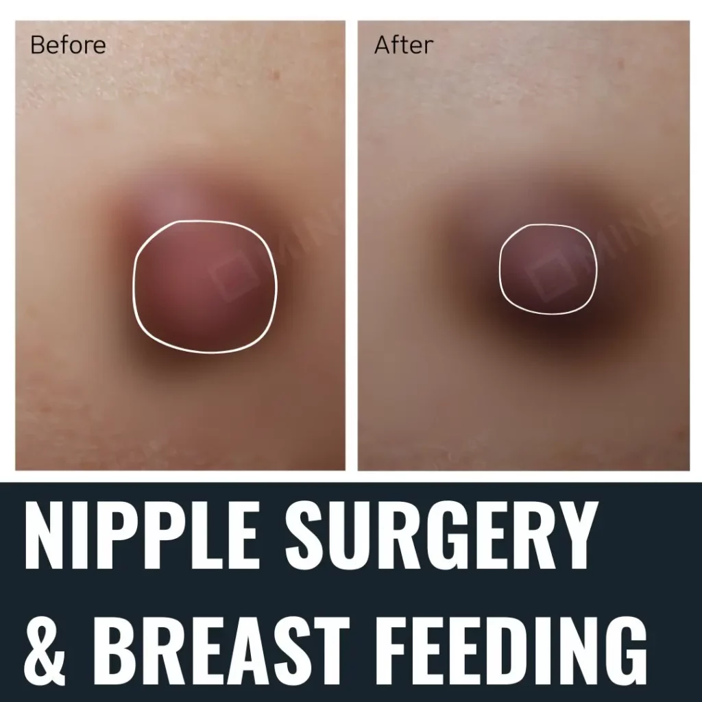 Before and after nipple surgery results showing reduction in nipple projection — nipple surgery and its effects on breastfeeding.
