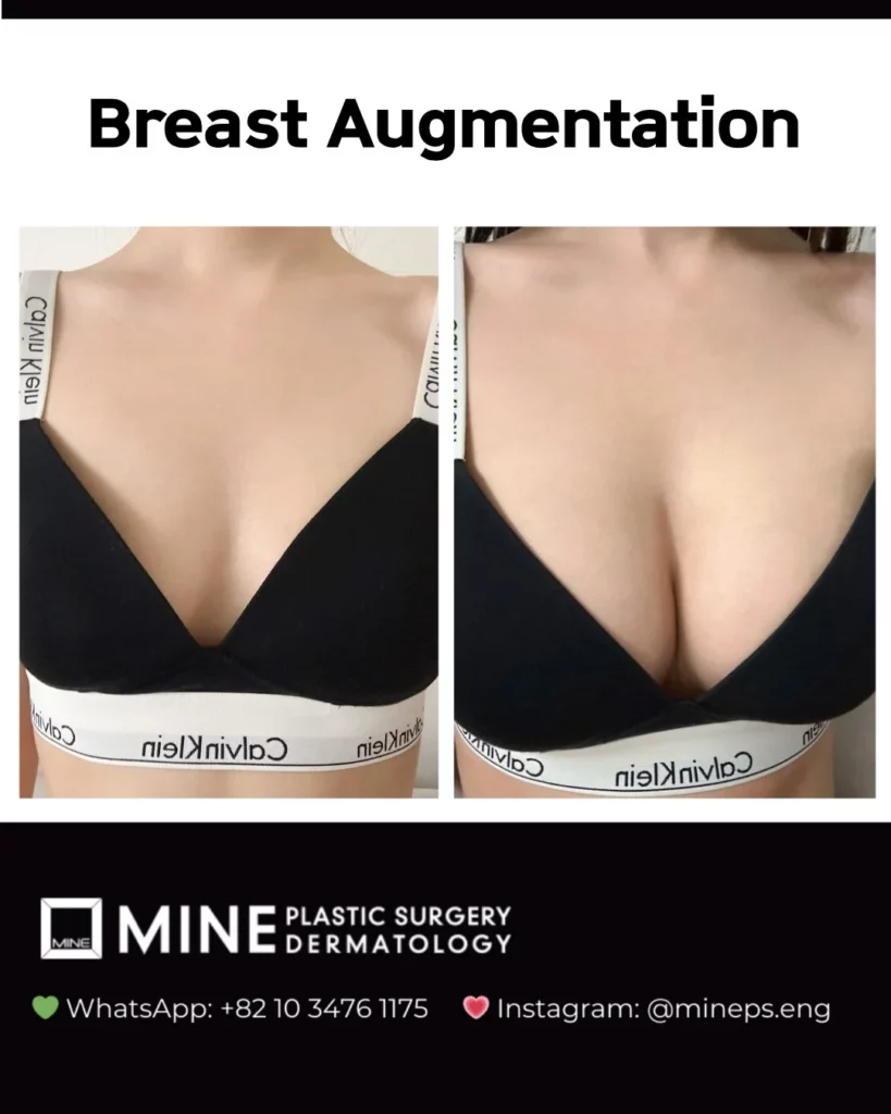 Breast augmentation surgery before and after photo showing natural-looking breast enlargement and improved cleavage at MINE Plastic Surgery Seoul, Korea.