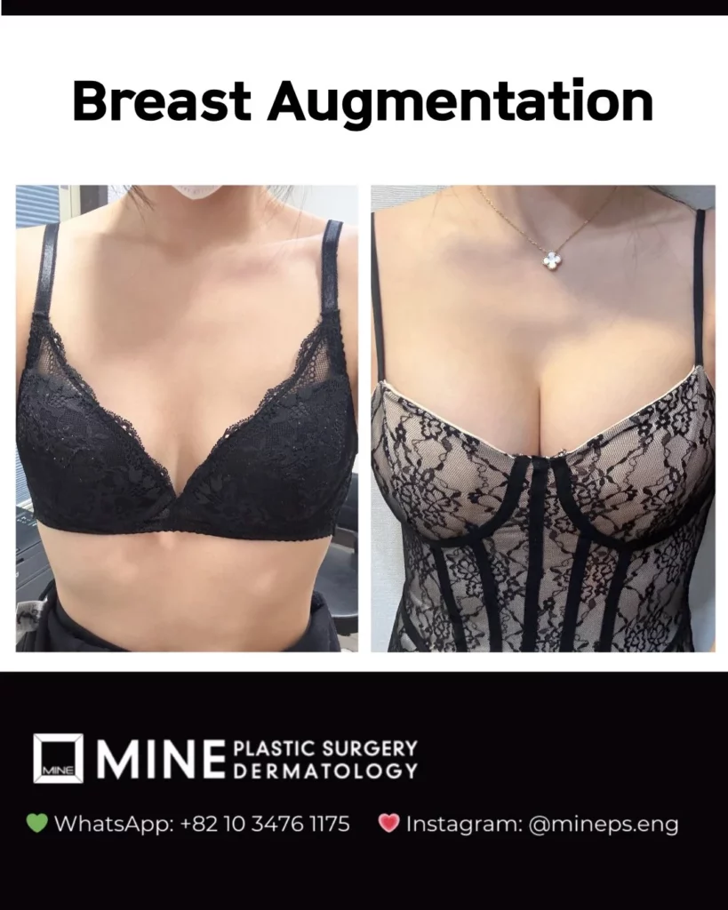 Breast augmentation surgery before and after results at MINE Plastic Surgery Seoul, showing fuller volume and enhanced cleavage in a female patient wearing a lace corset.