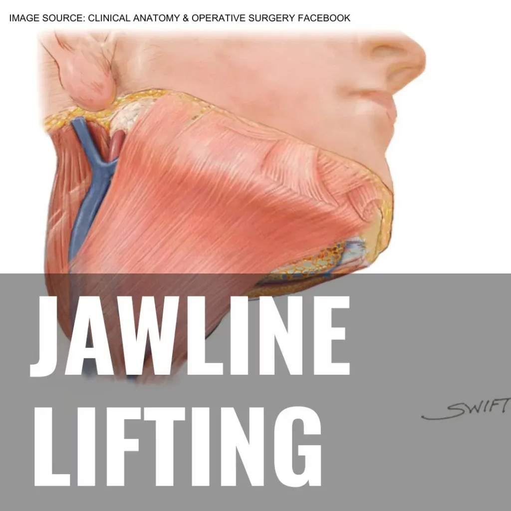 Clinical anatomy illustration showing the platysma muscle layer and subplatysmal fat in the neck and jaw region — used to explain jawline lifting surgery structures at Mine Clinic Seoul, Korea.