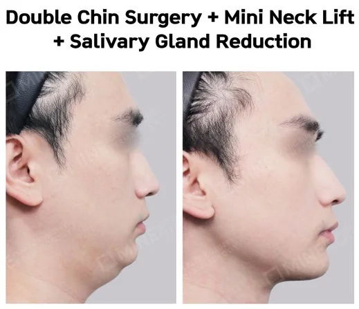 Male patient before and after side profile showing a sharper jawline following combined Salivary Gland Reduction, Mini Neck Lift, and Double Chin Surgery at Mine Clinic Seoul.