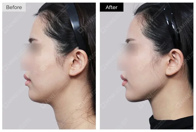 Before and after side profile of a female patient showing a slimmer, more defined jawline following Salivary Gland Reduction at Mine Clinic Seoul.